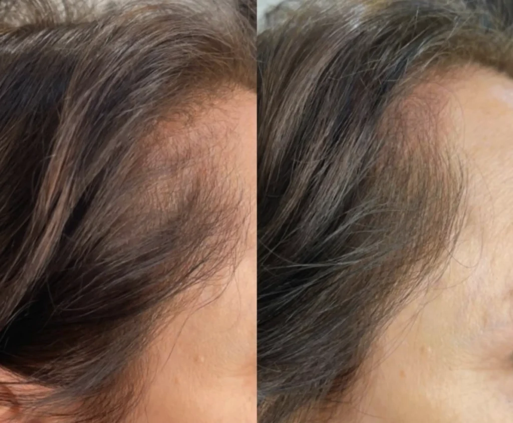 hair micropigmentation