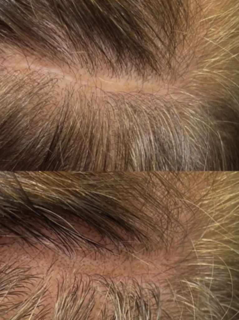 hairline tattoo