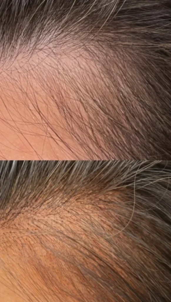 hairline tattoo brisbane