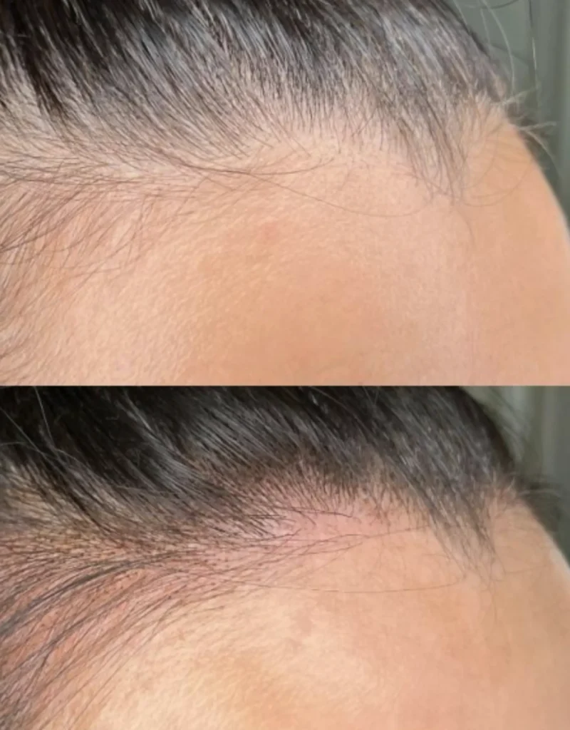 hairline tattoos