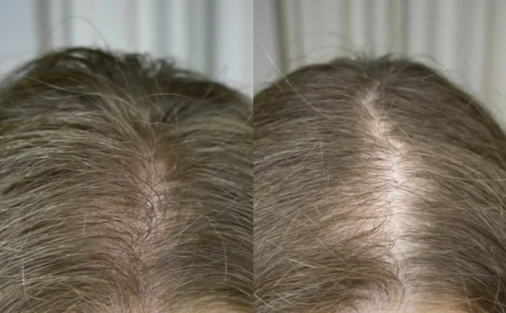 scalp micropigmentation